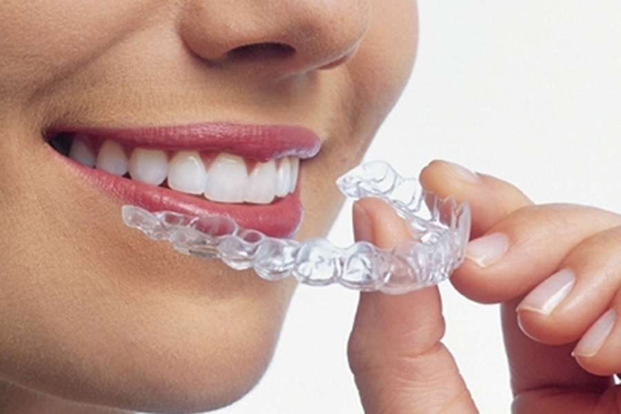 マウスピース型カスタムメイド矯正(歯科)装置(インビザラインなど